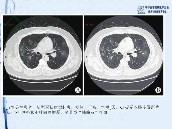 冠肺最新情况